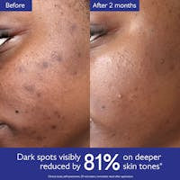 Radiant Glow Kit: Clinical Dark Spot Eraser for All Skin Tones
