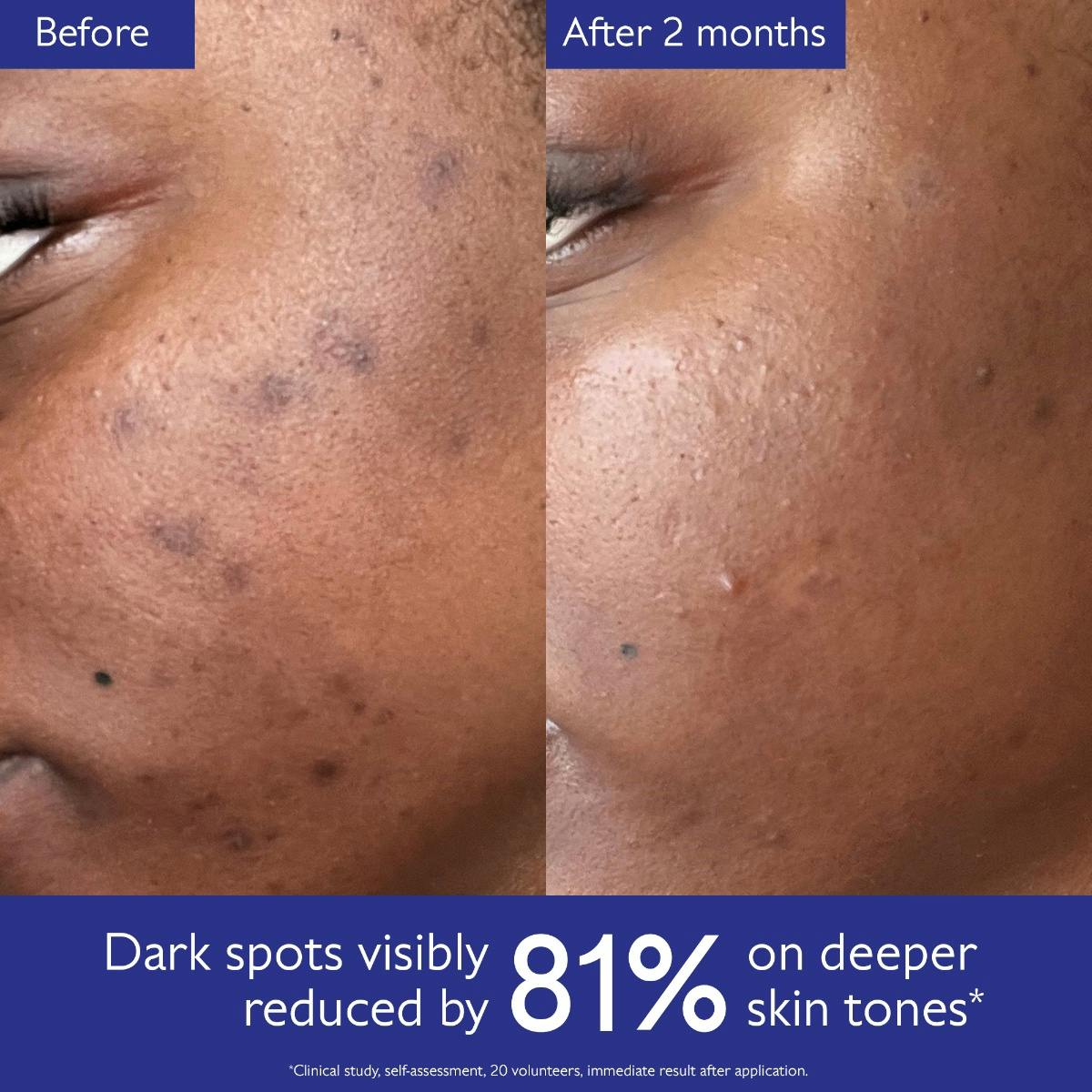 Radiant Glow Kit: Clinical Dark Spot Eraser for All Skin Tones