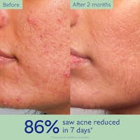 Clear Skin Complete Kit: 3-Step Acne Treatment System with Clinical Results