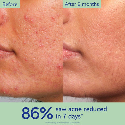 Clear Skin Complete Kit: 3-Step Acne Treatment System with Clinical Results